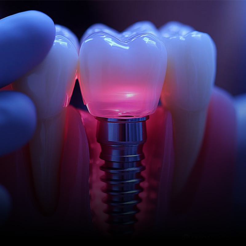 DENTAL IMPLANTS