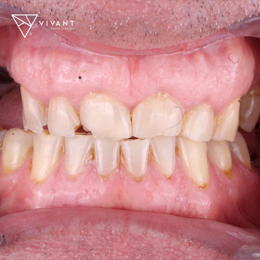 VIVANTSMILEDESINGBRIDGE-OVER-IMPLANT3