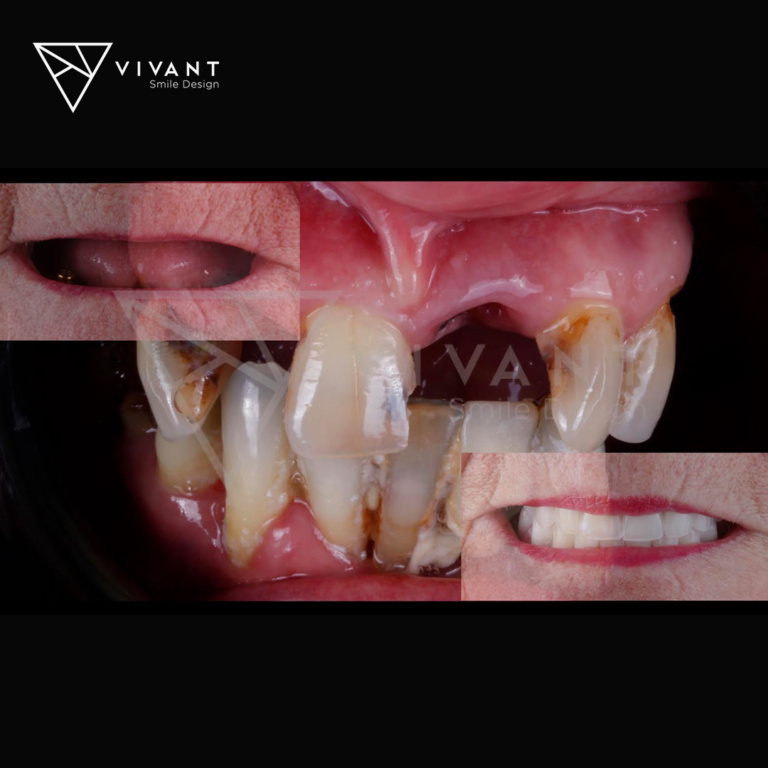 vivantsmiledesingIMPLANTES-SNAP-ON3-768x768