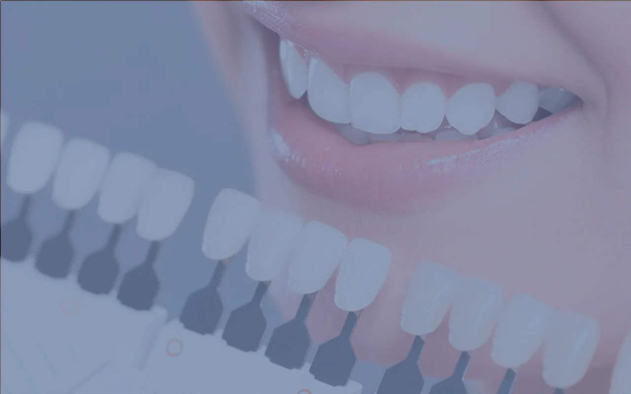 How to Take Care of Your Dental Veneers: A Complete Guide.Dental Clinic in Los Algodones México.